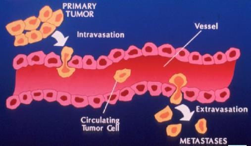 4) metastasi Le metastasi sono impianti tumorali discontinui rispetto al