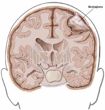 neuroepiteliali