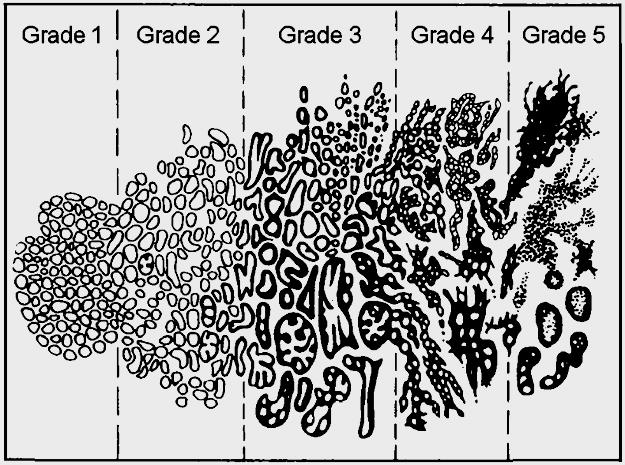 Staging Progressione Clinica - TNM Grading Differenziazione