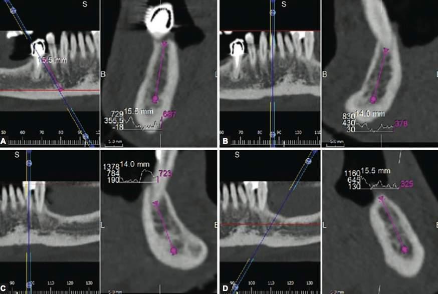 An intraoperative site-specific bone density device: a pilot test case. Arosio P, Moschioni M, Banfi LM, Di Stefano DA J Contemp Dent Pract. 2015; 16:697-703.