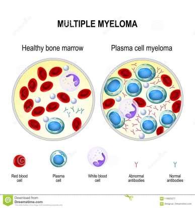 La crescita anomala delle plasmacellule può anche ostacolare quella normale di altre cellule