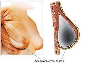 ADM- matrici dermiche acellulari 20 studi 2001-2012 3331 ricostruzioni 16 % PMRT PMRT aumenta il tasso