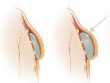 Mastectomia + riconstruzione con protesi in 2 tempi RT