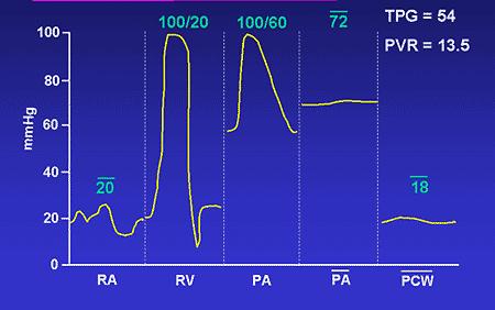 end- stage PAH