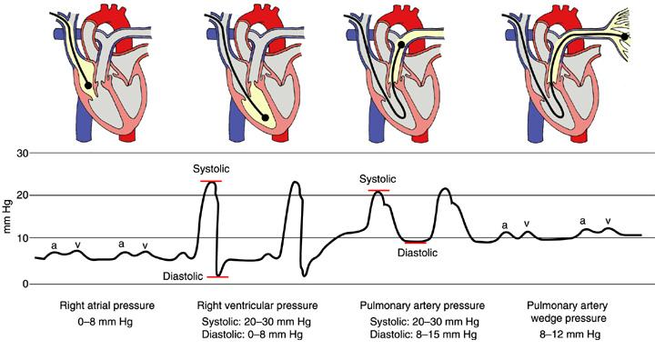 Parametri del Cateterismo Cardiaco Destro Indice Cardiaco (IC): 2.