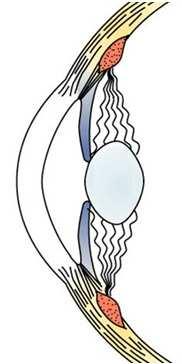 Contrazione muscolo ciliare 2.