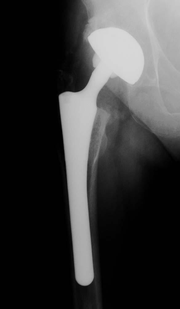 Interventi di revisione di uno stelo femorale Tre obiettivi eliminare il dolore,