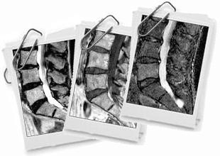 Protocollo Lombosacrale: - SAG TSE T2 - SAG TSE T1 - COR o SAG STIR - AX TSE T2 Se lesioni sospette