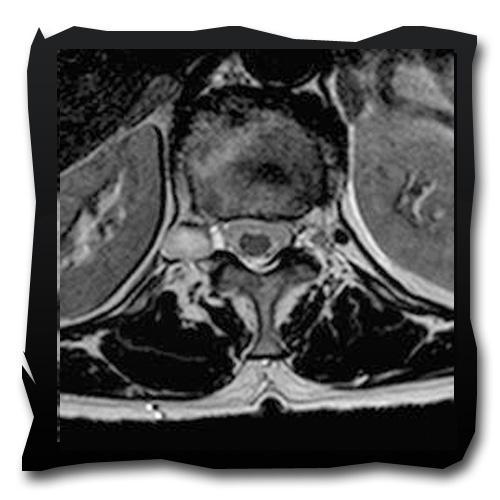 Tecniche Speciali Tra le tecniche speciali sulla RM Lombare e possibile citare le