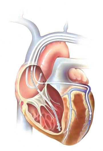 2) breve stimolazione cardiaca, in grado di interrompere, in maniera del tutto asintomatica, tachicardie meno rapide e regolari.