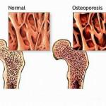 OSTEOPOROSI LA "MALATTIA" SILENZIOSA di Dario Armaroli MD L osteoporosi è una malattia a carattere progressivo dell apparato scheletrico caratterizzata da una bassa densità minerale ossea e da un