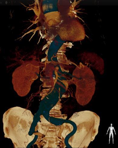 Registrazione del gruppo di dati 3D preoperatori con il sistema radiologico per