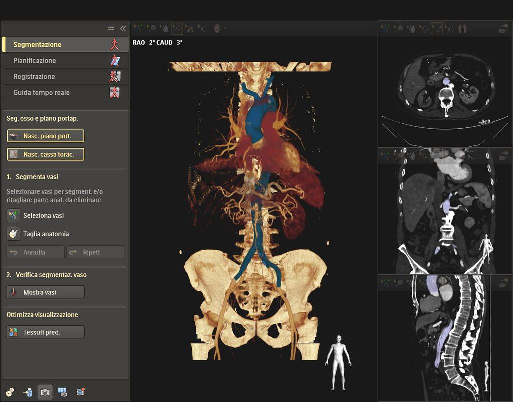 Il workstep della SEGMENTAZIONE viene utilizzato per selezionare l'anatomia da visualizzare durante la procedura.