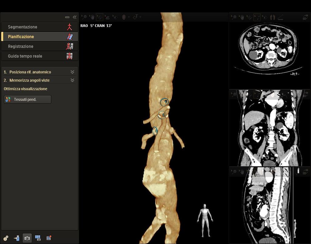 Il workstep della PIANIFICAZIONE viene utilizzato per pianificare la procedura mediante la preparazione del volume ricostruito in 3D attraverso: Aggiunta dei riferimenti anatomici
