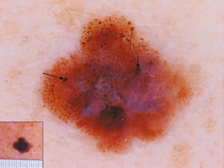 epiluminescenza o del microscopio confocale andrebbe