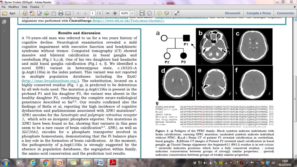 Famiglia con mutazione XPR1 Figura 1: a) Albero genealogico di una famiglia PFBC. I simboli in nero indicano i soggetti con calcificazioni cerebrali, portatori di mutazione XPR1.