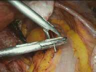 )"+"(* Isterectomia totalmente laparoscopica Miomectomia laparoscopica, Ureterocistoneostomia e chirurgia vescicale per