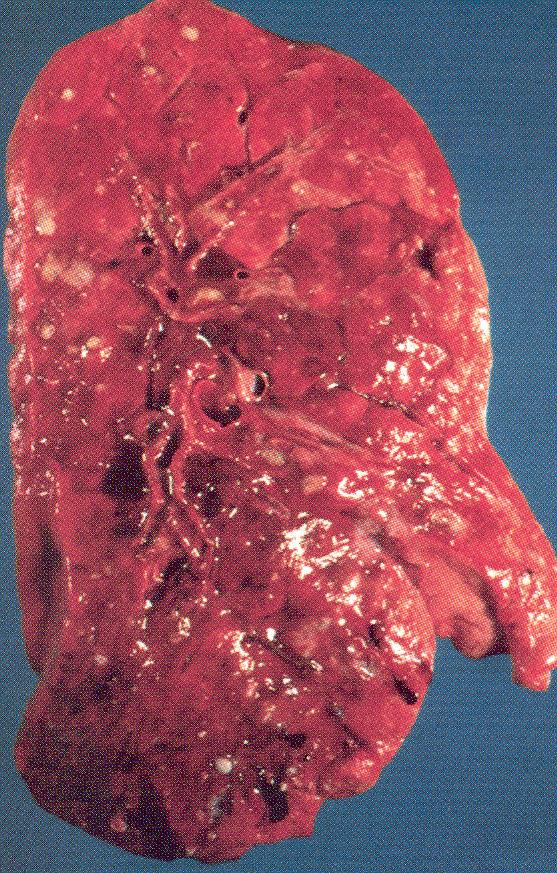 Fibrosi cistica (mucoviscidosi) Caratteristiche cliniche: malattia polmonare cronica, insufficienza pancreatica esocrina, crescita stentata, azoospermia ostruttiva, ileo da meconio, aumentata