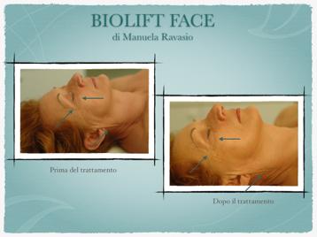 Biolift Face è una tecnica innovativa dedicata al trattamento degli inestetismi che interessano la zona del contorno occhi, contorno labbra, ovale del viso, collo e décolleté.