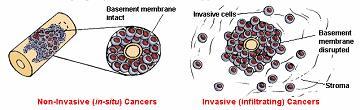 Tumori in situ e tumori invasivi E possibile la