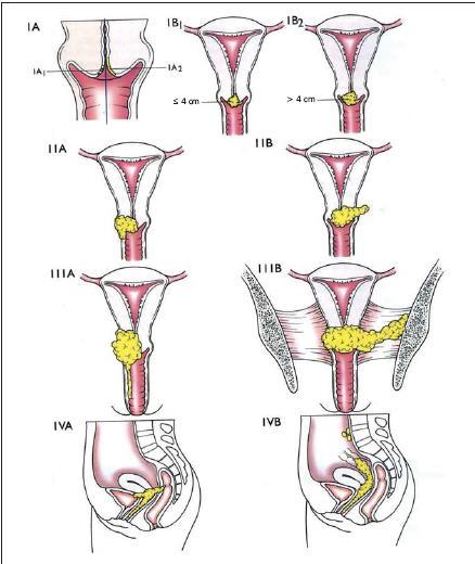 Storia naturale del tumore della cervice Il carcinoma della cervice uterina diffonde per estensione diretta: continuità (canale cervicale, corpo uterino, parete alta vagina) e per contiguità