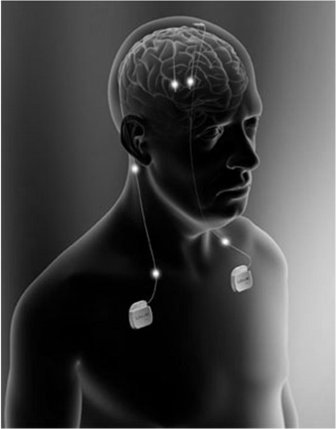 DEEP BRAIN STIMULATION Trattamento per i