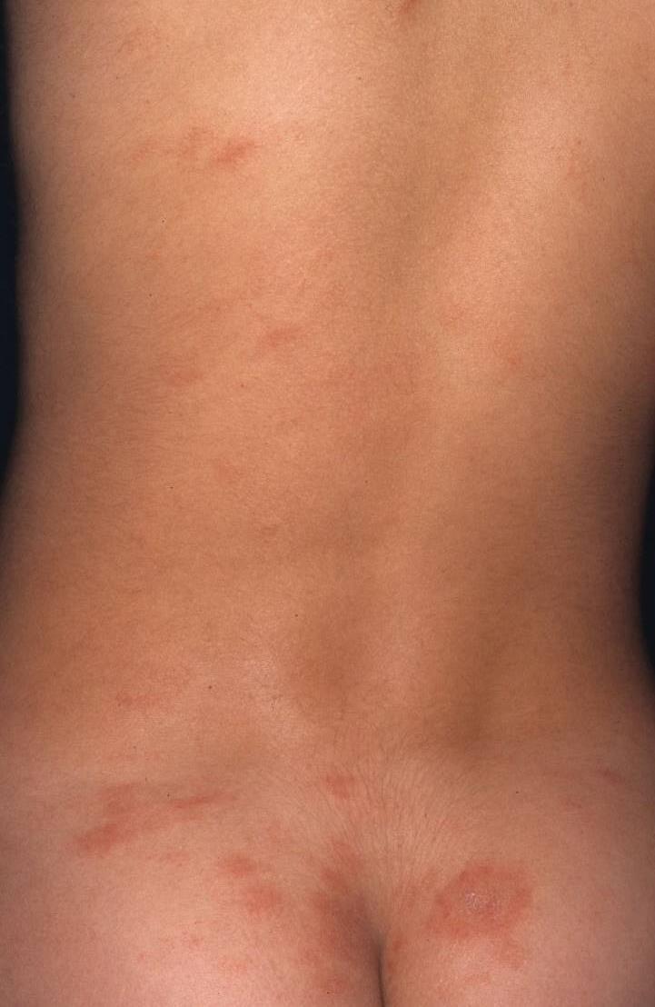 Pityriasis Rosea