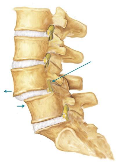 Spondilolistesi: definizione e classificazione (p. 1) 2. Diagnosi (p. 3) 3. Trattamento della spondilolistesi (p. 5) 4. Esempio di tecnica chirurgica (p. 7) 1.