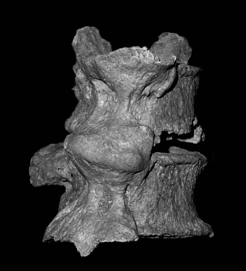 OSTEOARTROSI PROCESSO DEGENERATIVO ARTICOLARE