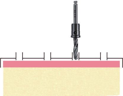 mascellare Togliere il tappo - l impianto è fissato al tappo con un punto di rottura predeterminato. 1.