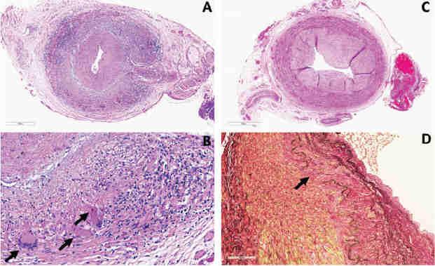 Arterite a Cellule Giganti Biopsia dell Arteria Temporale: Gold-Standard per la diagnosi Infiammazione transmurale ma