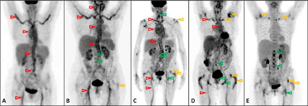 Polimialgia Reumatica e Arterite a Cellule Giganti