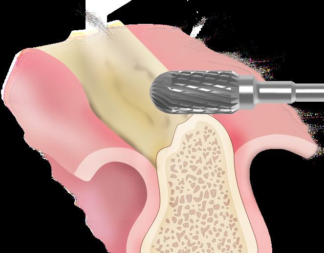 Osteoplastica della cresta ossea: tecnica per un livellamento rapido e