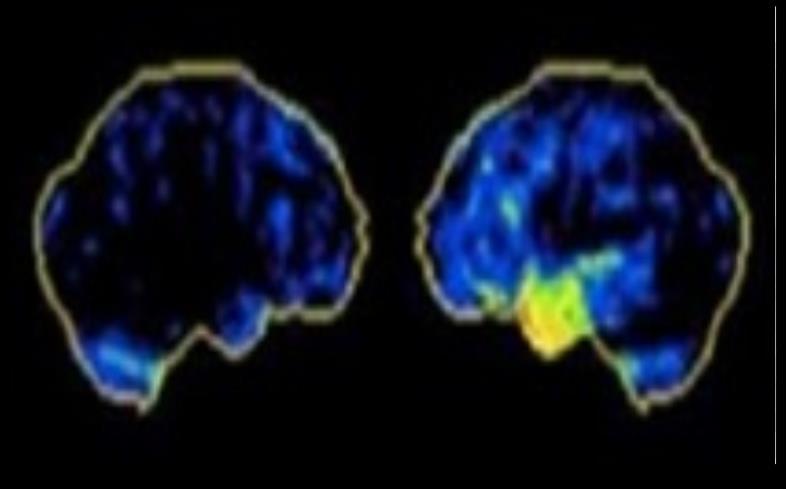 Le Afasie Primarie Progressive: diagnosi CRITERI DIAGNOSTICI -anomie -alterata comprensione di singole