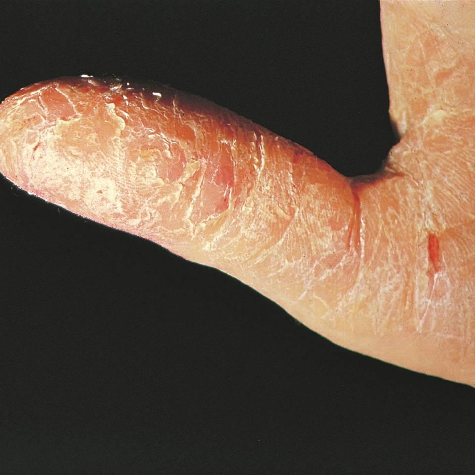 dermatite da contatto irritativa). Questa patologia si manifesta con arrossamento della pelle, gonfiore e desquamazione associati a senso di bruciore e/o prurito.