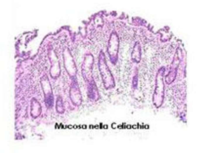 < 2 aa) 2) Biopsia enterica Esame della