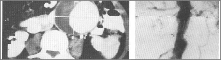 INDAGINI STRUMENTALI E RADIOLOGICHE Rx diretta addome in due proiezioni