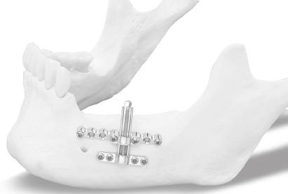 Distraction device to uplift the alveolar site: In order to obtain the proper distraction verticality of the bone segment, the anchorage of the mobile body must be thickened with Cizeta Surgical