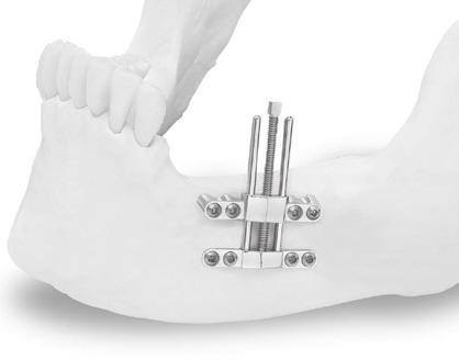 Distraction device to uplift the alveolar site: In order to obtain the proper distraction verticality of the bone segment, the anchorage of the mobile body must be thickened with Cizeta Surgical