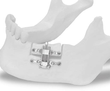 01 - AL-B Distrattore alveolare bidirezionale FAD Alveolar distractor 01 - AL-B FAD bidirectional alveolar distractor Osteodistrattore alveolare bidirezionale o floating alveolar device (FAD),