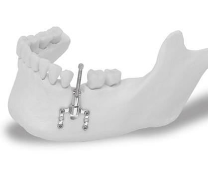 The device rear spline prevents the rotation of the bone segment during distraction.