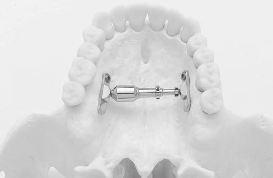 The distraction screw is made in such a way that at its maximum opening, it cannot be disassembled; appropriately anchored to a tooth or a screw, it cannot be ingested by the patient.