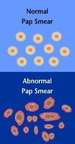 Il Test di Papanicolaou o Pap test è un esame citologico che indaga le