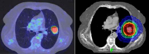 RT e imaging biomolecolare, p.4 Fig 6: immagine PET/TC sulla sinistra con accumulo patologico di tracciante in sede polmonare parenchimale.