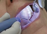 IGIENE DENTALE L utilizzo degli ultrasuoni consente di pulire i denti accuratamente e in maniera leggera e di rimuovere placca e tartaro in modo approfondito.