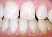 CONSERVATIVA Questa branca dell Odontoiatria consente di ricostruire i denti a etti da patologie cariose o che hanno subito traumi con l ausilio di materiali da restauro (resine composite) usati