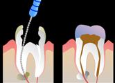 ENDODONZIA L endodonzia è un settore dell odontoiatria che si occupa dell endodonto, lo spazio all interno del dente che contiene la polpa dentaria (ovvero il tessuto molle costituito da bre nervosa,