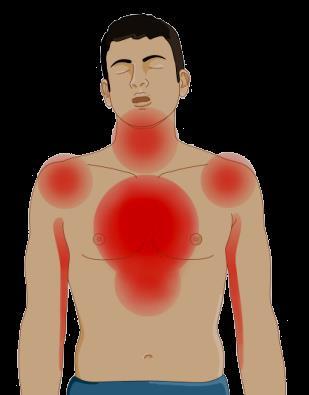 Dolore costrittivo, irradiato, opprimente o bruciante nella regione sternale o del cuore