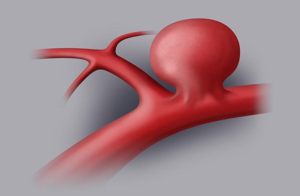 GLI ANEURISMI INTRACRANICI Gli aneurismi intracranici sono dilatazioni patologiche della parete di un vaso e possono svilupparsi a causa di diversi