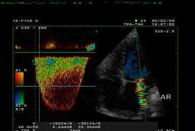 STUDIO DELLA FUNZIONE SISTOLICA DEL VS dp/dt(velocità di aumento della pressione intraventricolare) Pressure (mmhg)